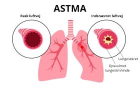 astma lung depiction